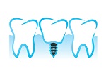 Implant in Richmond Hill