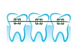 Braces in Richmond Hill